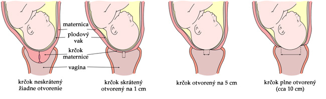 Diltácia krčka maternice počas prvej doby pôrodnej